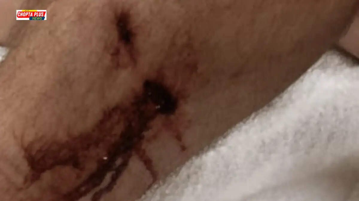 Haryana Teacher Kuldeep Singh Dog Bite During Census Duty Bakariyanwali Nathusari Chopta